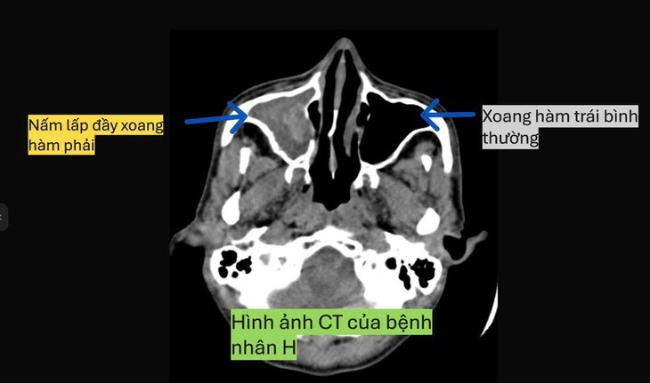 Viem xoang do nam can than bien chung nguy hiem gay mu loa
