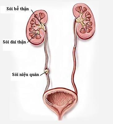 Bien chung kho luong cua soi nieu quan, cach phong tranh