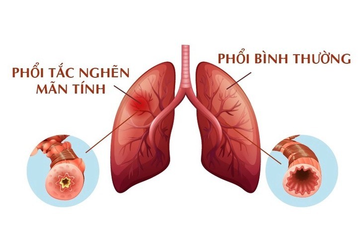 Cach doi pho voi benh phoi tac nghen hon 380 trieu nguoi mac