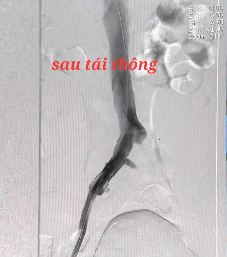Chân đau phải mổ cấp cứu vì tắc tĩnh mạch chậu đùi cấp - Hình 3 Chan dau phai mo cap cuu vi tac tinh mach chau dui cap-Hinh-3