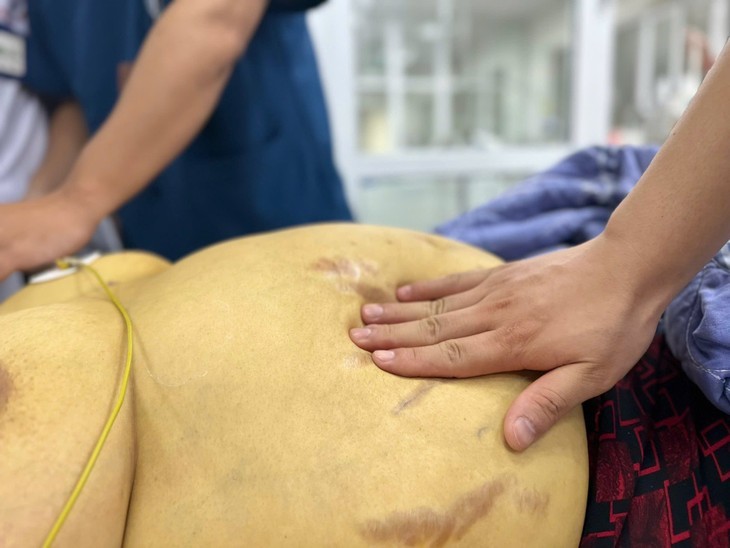 Suy gan nguy kịch do chủ quan với viêm gan B - Hình 2 Suy gan nguy kich do chu quan voi viem gan B-Hinh-2