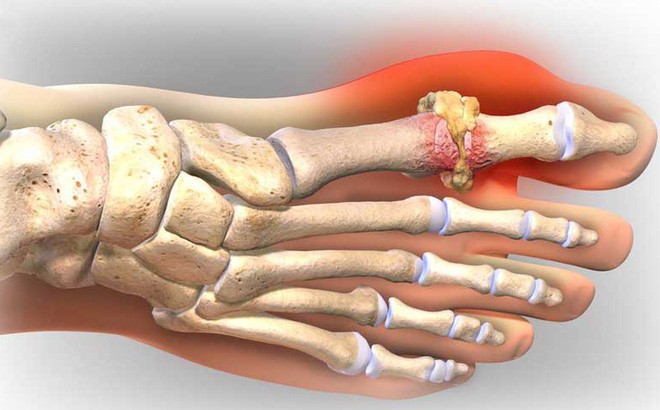 Dau hieu chung to ban da mac benh gout-Hinh-5