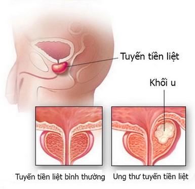 Ung thu tuyen tien liet, ai co nguy co cao de mac benh?