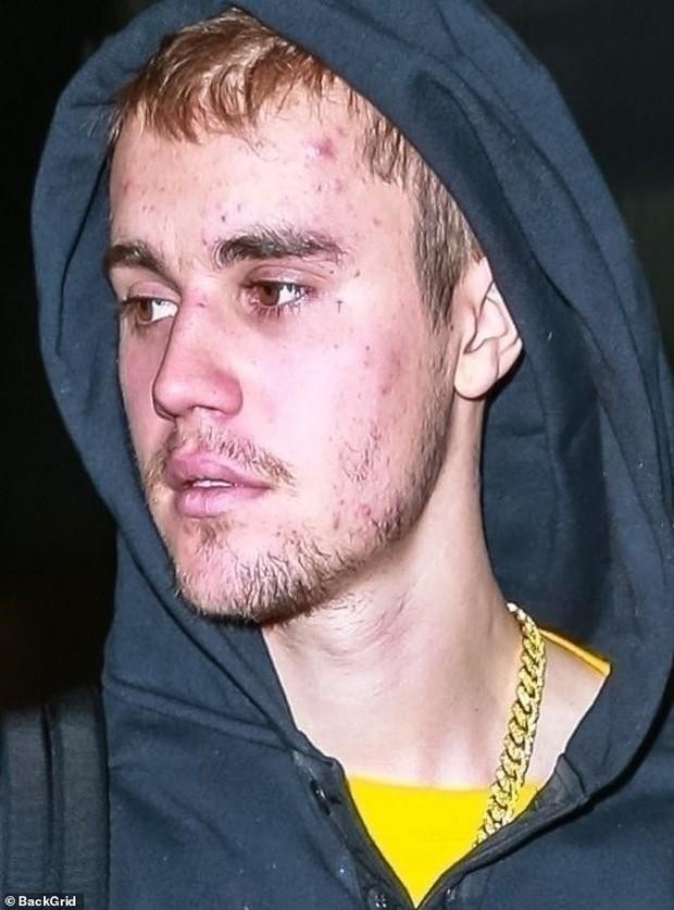 Justin Bieber mac benh kho tri khien ngoai hinh ngay cang tieu tuy-Hinh-2