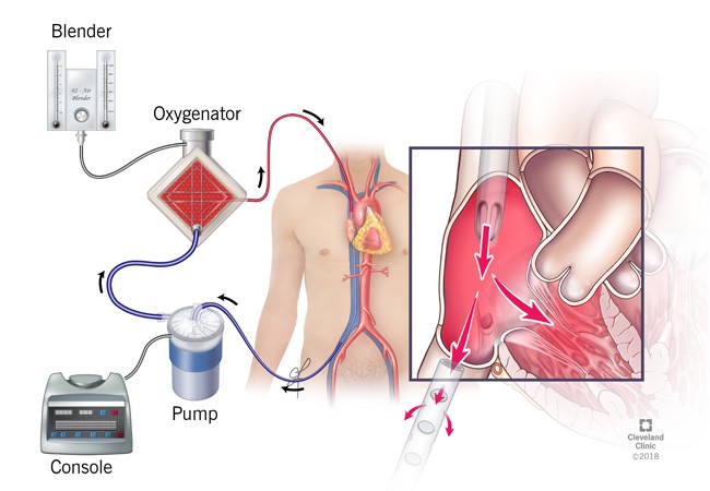 Duoc chi dinh can thiep ECMO, bac gai benh nhan 17 nang the nao?-Hinh-2