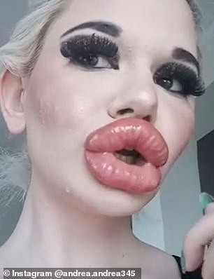 Kinh dị đôi môi dày nhất thế giới của cô gái bơm môi 20 lần