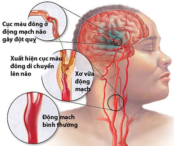 Nhac si Phu Quang mac bien chung tieu duong nguy hiem toi muc nao?-Hinh-3