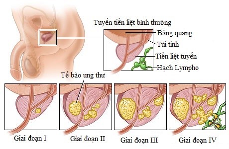 Benh ung thu cua nguyen Bo truong Vu Huy Hoang co nguy hiem?-Hinh-2