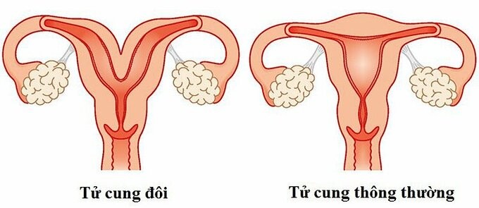 Hiem gap: San phu 20 tuoi co 2 tu cung, sinh con nguy hiem?-Hinh-2