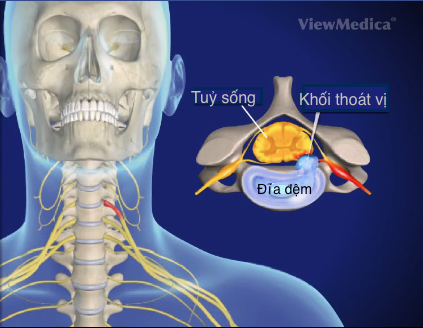 Nhũng ai dẽ bị thoát vị dĩa dẹm nhu nguòi mãu Thái Hà?-Hinh-2