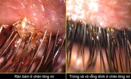 Nhũng truòng họp rạn mu ký sinh lúc nhúc dụng tóc gáy-Hinh-9