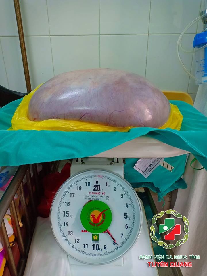 Phau thuat thanh cong cho co gai 22 tuoi mang khoi u buong trung gan 8kg