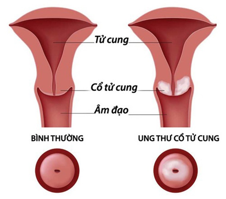 Dau hieu nhan dang cac loai ung thu thuong gap-Hinh-6