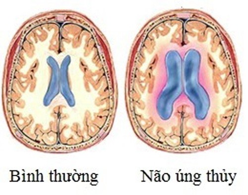 Benh nao ung thuy cua Quoc vuong Thai Lan có dáu hiẹu gì?-Hinh-11