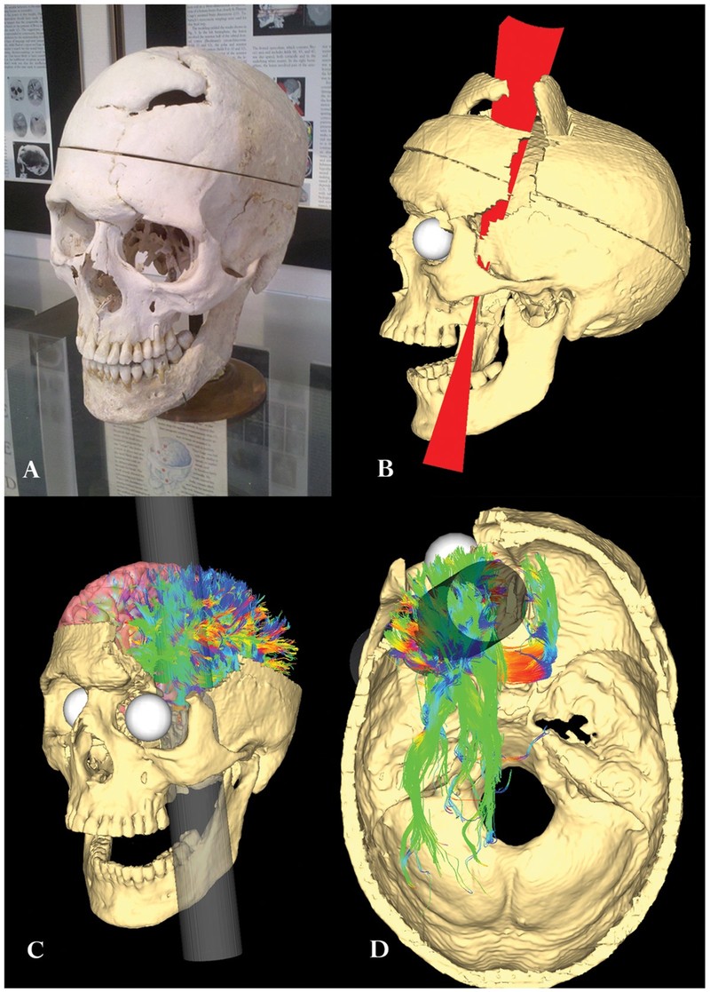 Phineas Gage va vu tai nan khai sinh ra khoa hoc than kinh hien dai-Hinh-3