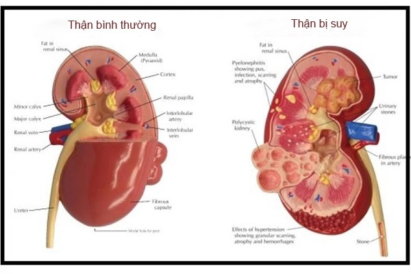 Nhung dau hieu canh bao than sap hong ma khong biet