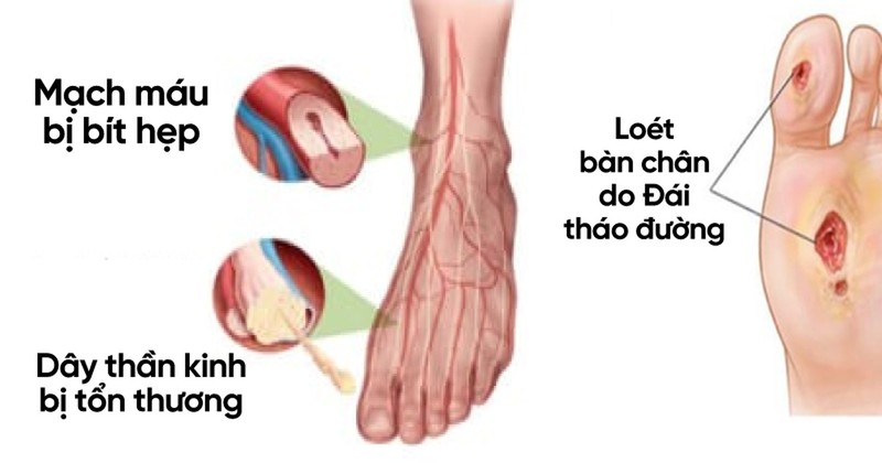 Loet ban chan nang vi 'buong bo' dieu tri dai thao duong-Hinh-2