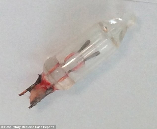Bác sĩ phát hiện đèn trang trí trong phổi bé gái 14 tháng - Ảnh 1