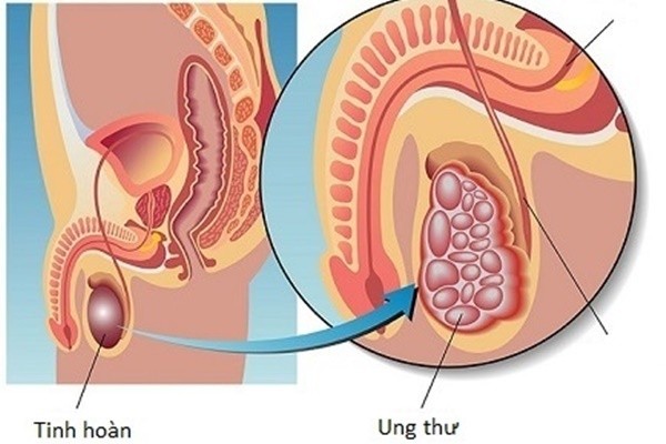 3 can benh ung thu neu phat hien som co the chua khoi hoan toan