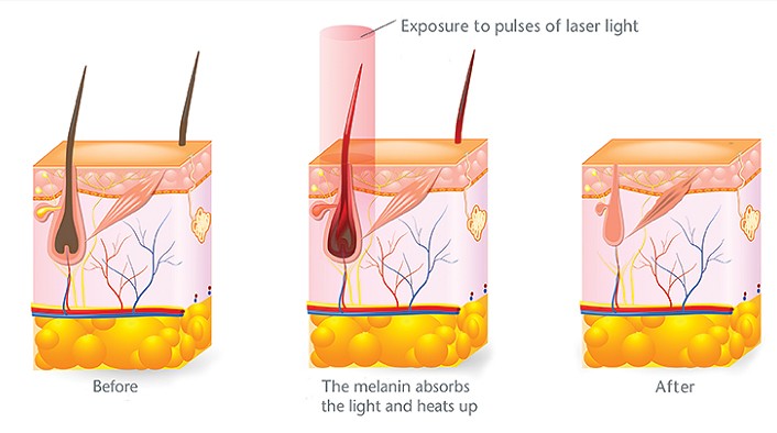 Su that hay bi lam tuong ve triet long bang laser