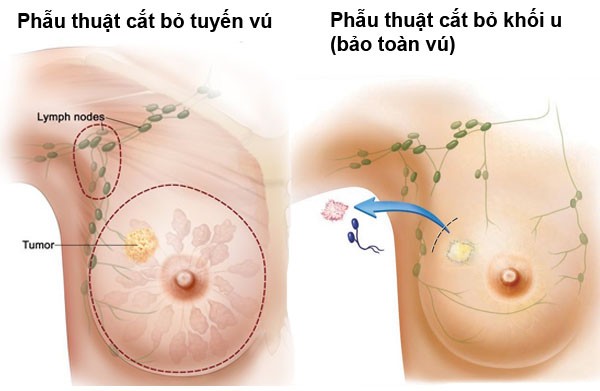 Nguy co tiem an khi chinh sua vong mot sau cat u vu-Hinh-3