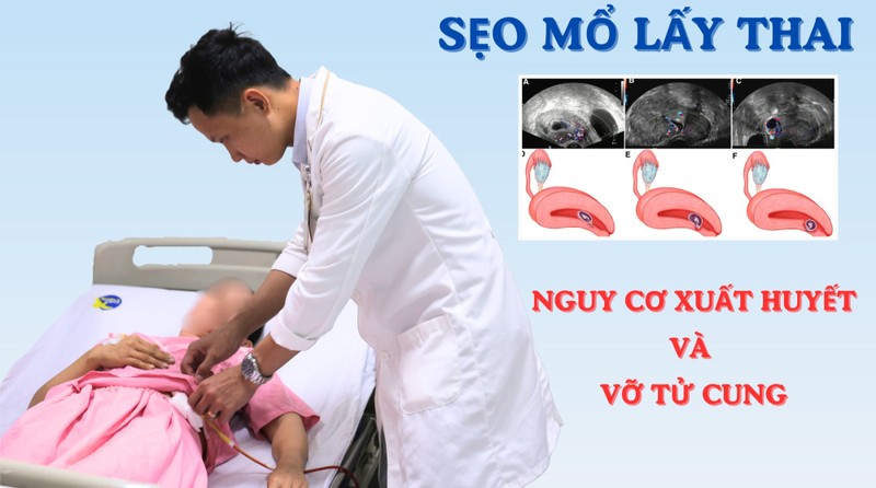 San phu 40 tuoi thai bam o seo mo nguy hiem tinh mang