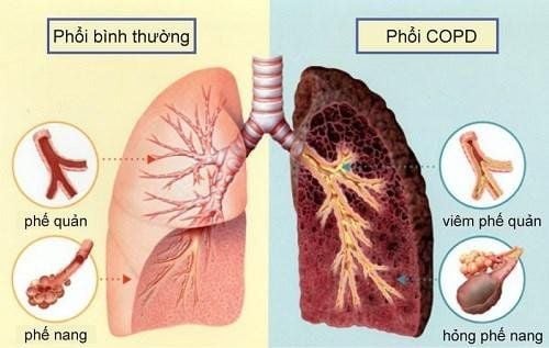 Cach phat hien benh phoi tac nghen man tinh - COPD