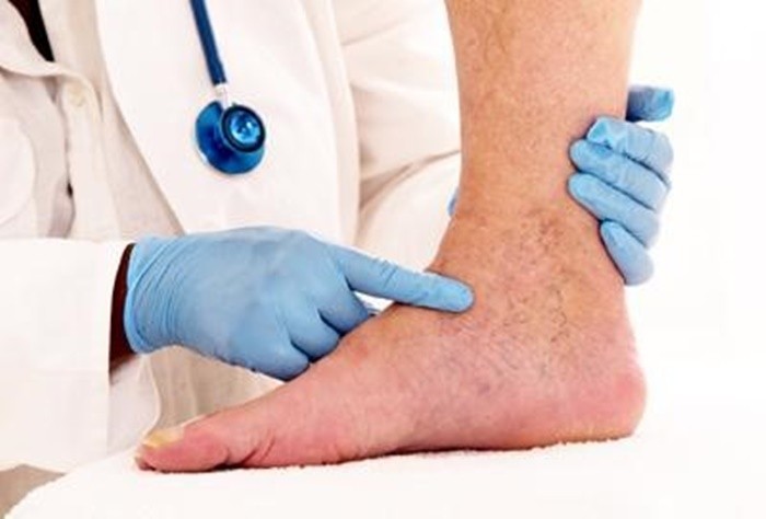 Chế độ dinh dưỡng cho người bệnh huyết khối tĩnh mạch sâu Che do dinh duong cho nguoi benh huyet khoi tinh mach sau