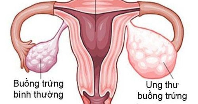 Dấu hiệu cảnh báo sớm ung thư buồng trứng Dau hieu canh bao som ung thu buong trung