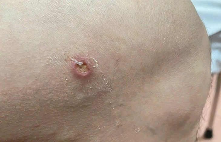 Phát hiện thêm ca bệnh giun rồng thứ 26 tại Phú Thọ Phat hien them ca benh giun rong thu 26 tai Phu Tho