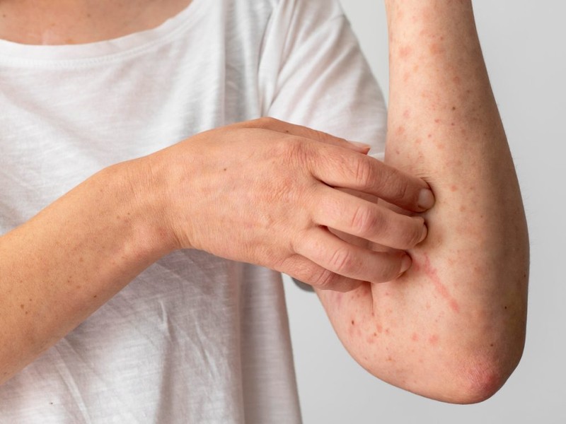 Nhiều bệnh da liễu phát triển trong mùa hè Nhieu benh da lieu phat trien trong mua he