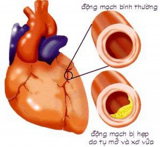 La do ngon - phuong thuoc huu hieu cho benh tim mach