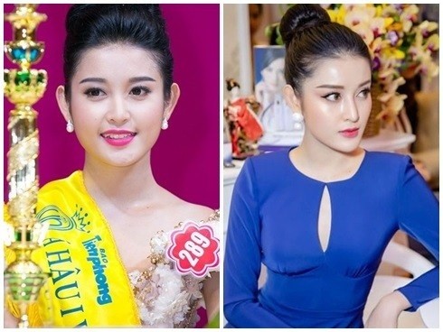 Huyen My phau thuat tham my hong, lien tuc de lo dang mui dieu hau?-Hinh-2