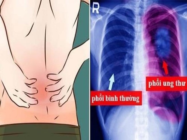 Ðau lung phia sau phoi co phai dau hieu ung thu?