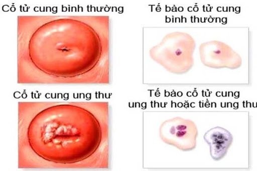 8 dau hieu ung thu co tu cung-Hinh-2