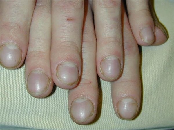 5 dấu hiệu bất thường ở ngón tay cảnh báo bệnh nguy hiểm