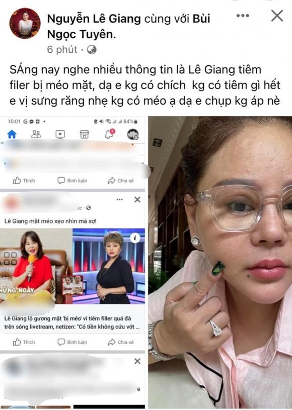 Le Giang phu nhan thong tin tiem filler den muc 'meo mat'-Hinh-3