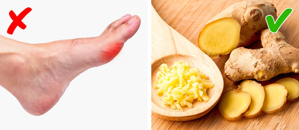 Tuyệt chiêu giảm đau hiệu quả cho người mắc bệnh gout - Hình 7 Tuyet chieu giam dau hieu qua cho nguoi mac benh gout-Hinh-7