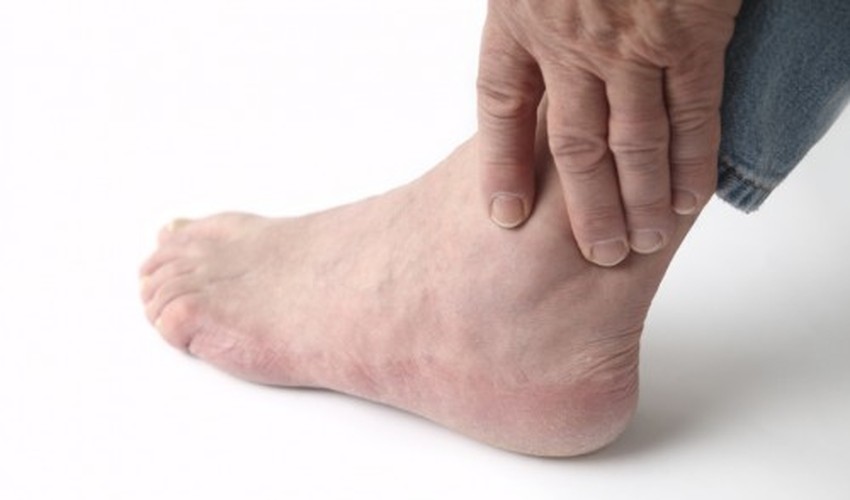Dấu hiệu chứng tỏ bạn đã mắc bệnh gout - Hình 3 Dau hieu chung to ban da mac benh gout-Hinh-3