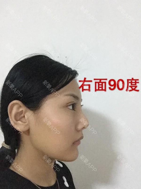 30 ngay bien hoa cua co nang phau thuat tham my