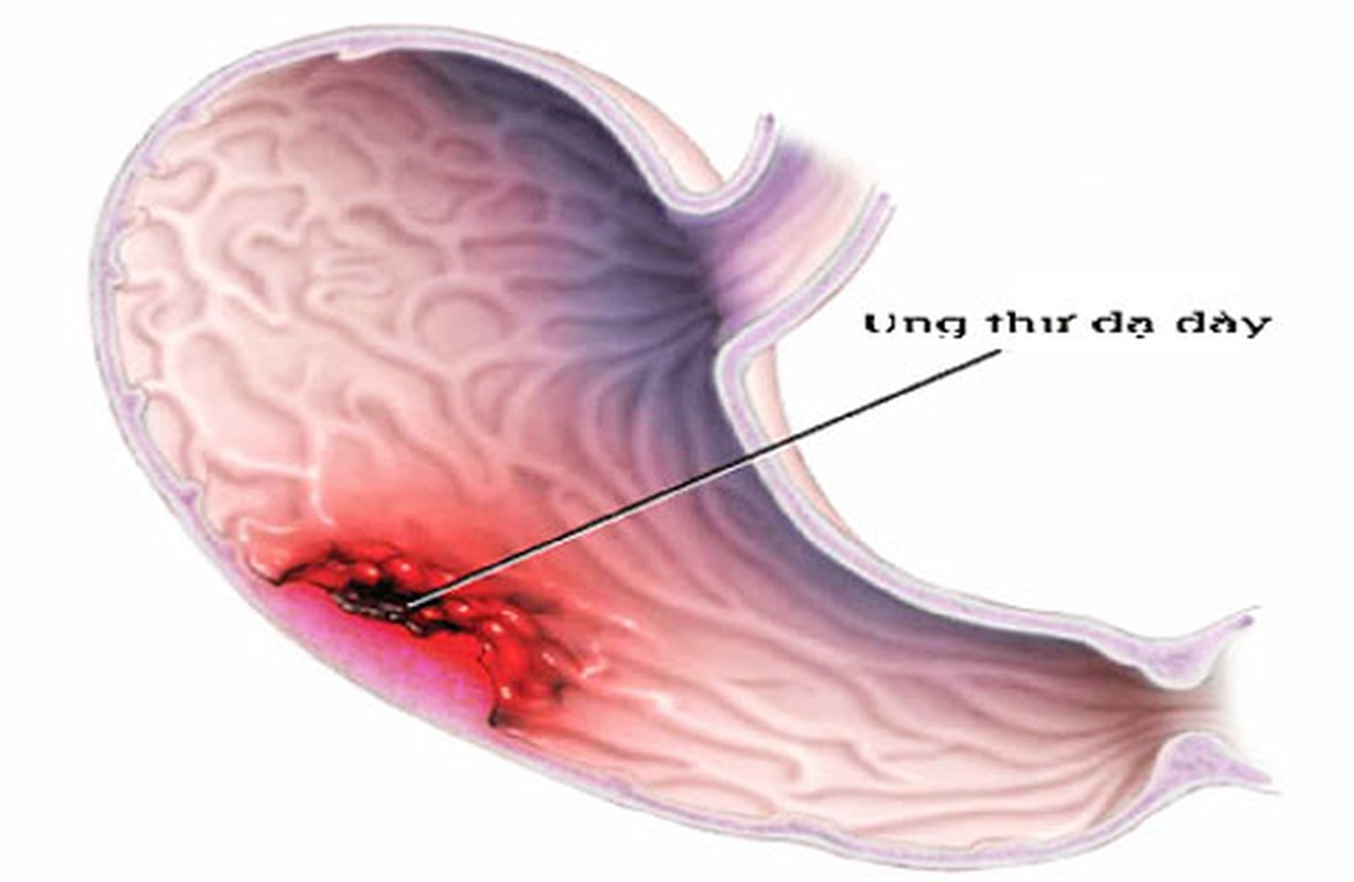 Diem mat cac loai ung thu do thuoc la gay ra-Hinh-4