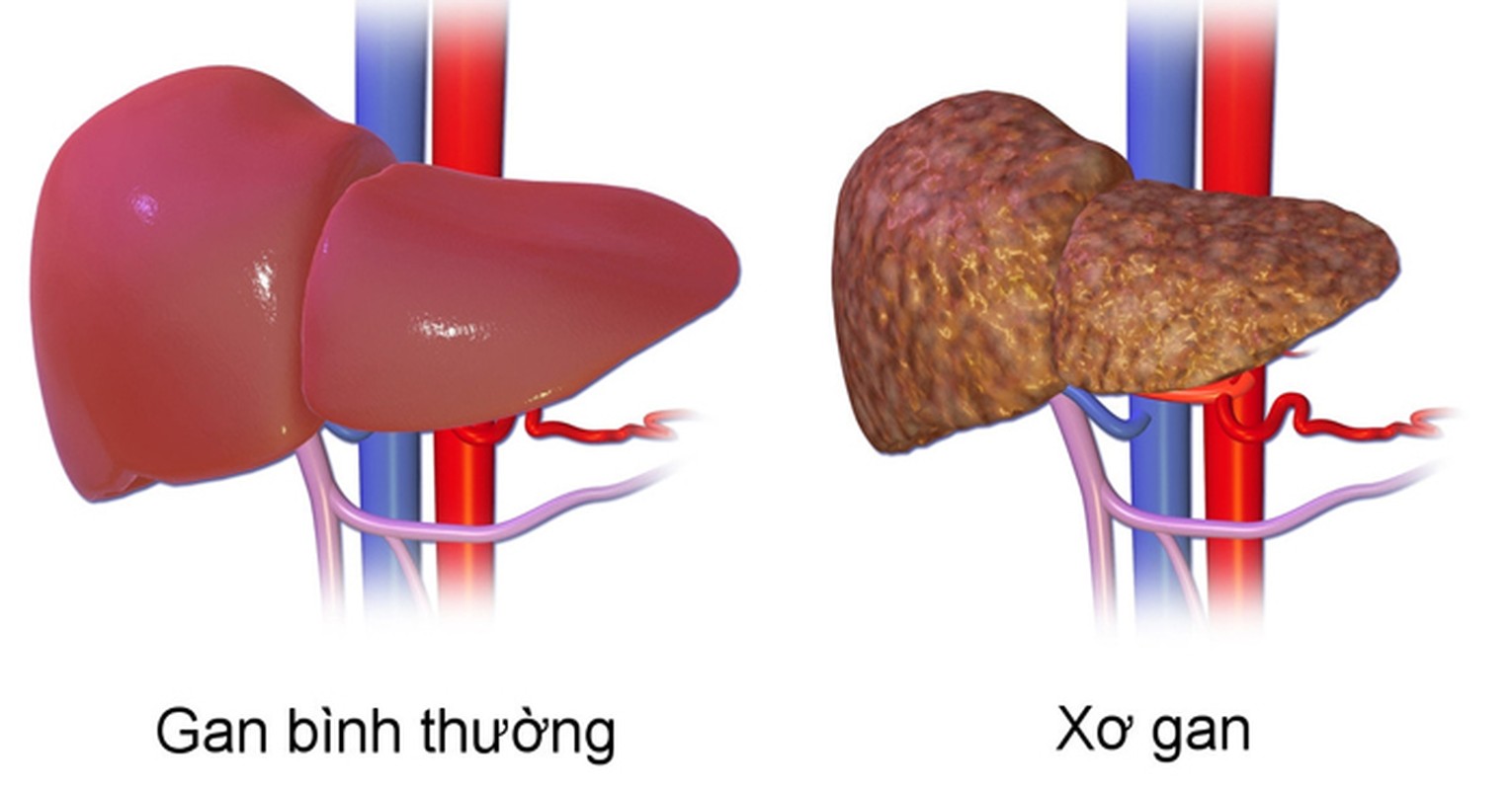 Soi bat thuong tren mong de biet gan bi xo tham te-Hinh-7