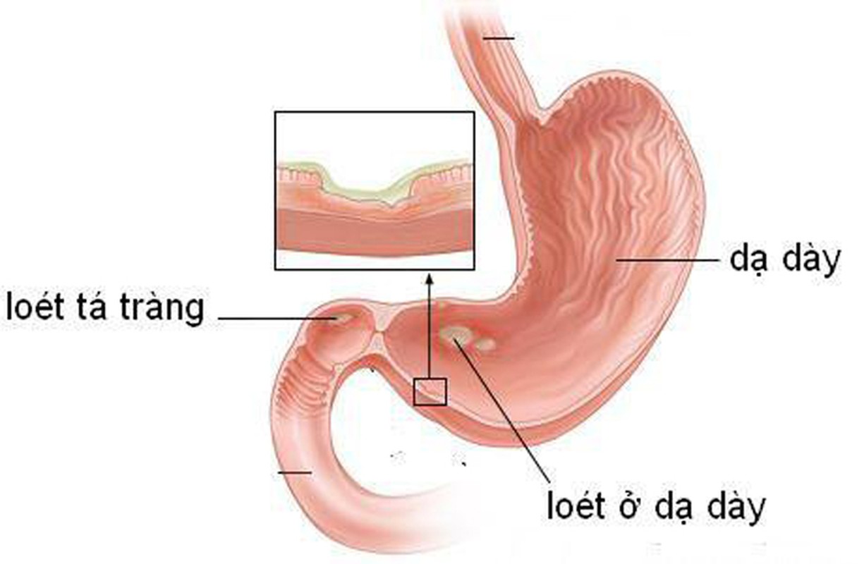 4 benh vat khong tri tan goc de gay ung thu da day-Hinh-8