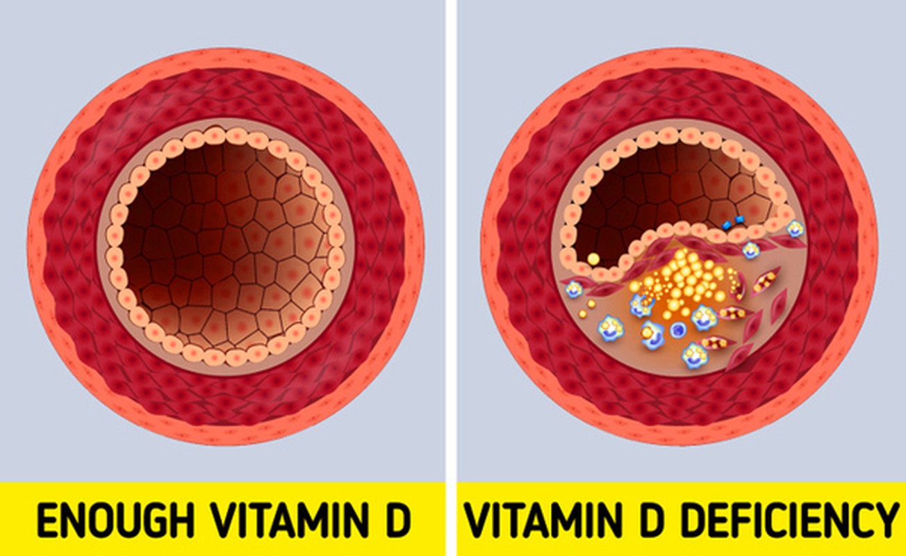 Giat minh loat dau hieu “to cao” co the thieu vitamin D tram trong-Hinh-5