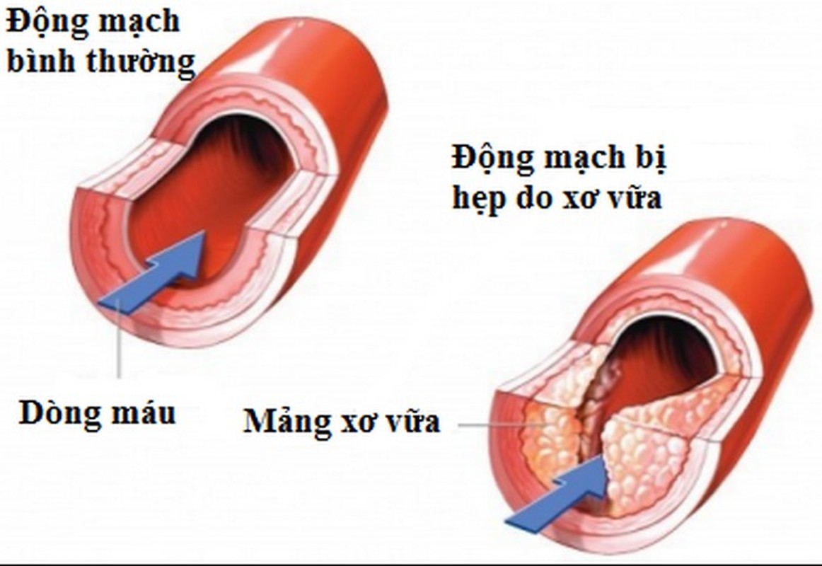 Bai thuoc tu giam gao chua dut benh soi than, huyet ap-Hinh-3