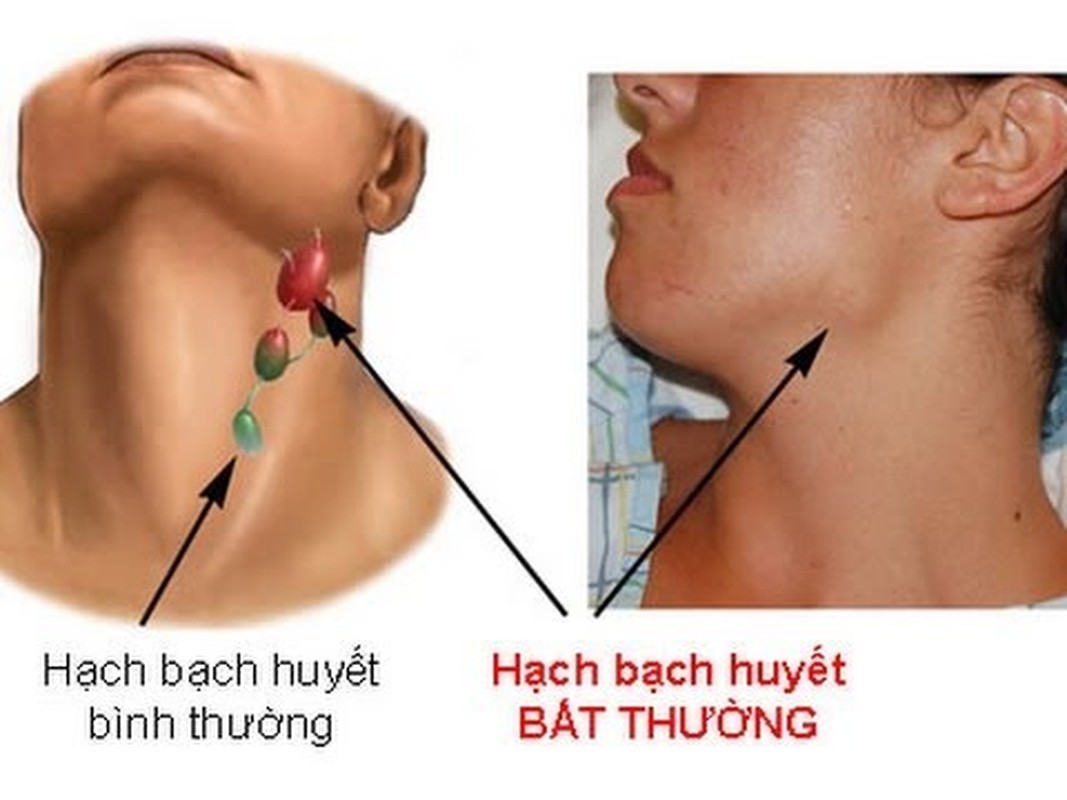 6 bai thuoc hay chua sung hach ma ban chua biet-Hinh-3