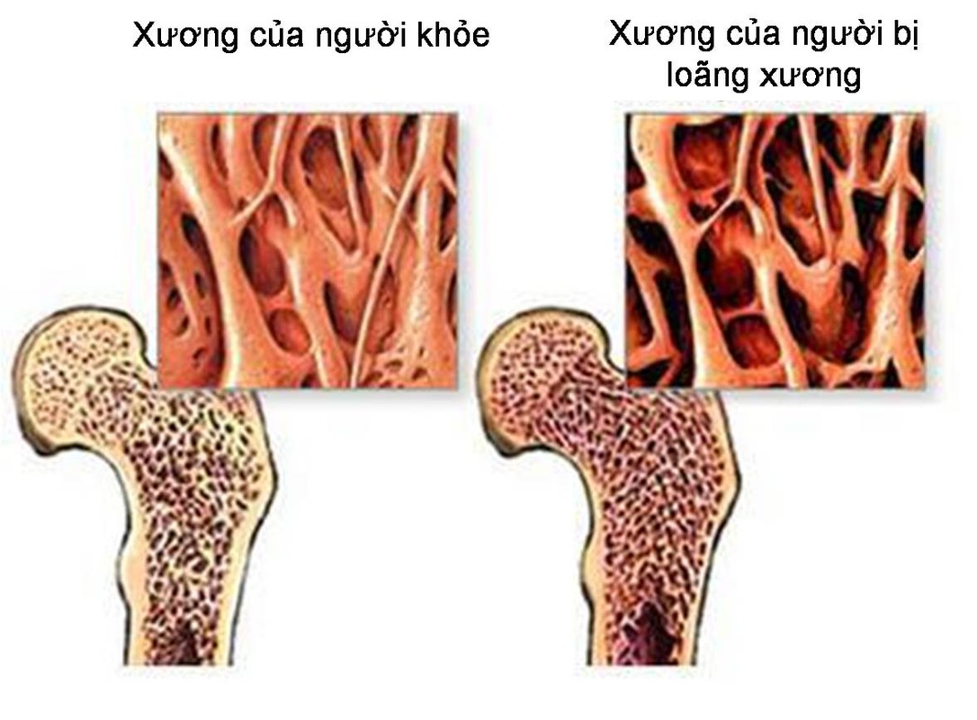 6 dau hieu thieu canxi dáng báo dọng tren co thẻ