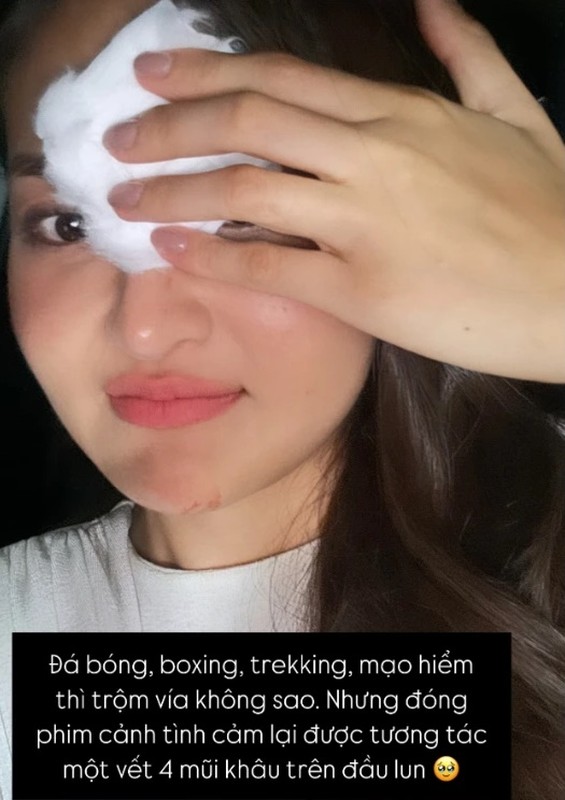 Thuy Anh khau 4 mui tren tran, loat sao gap tai nan phim truong