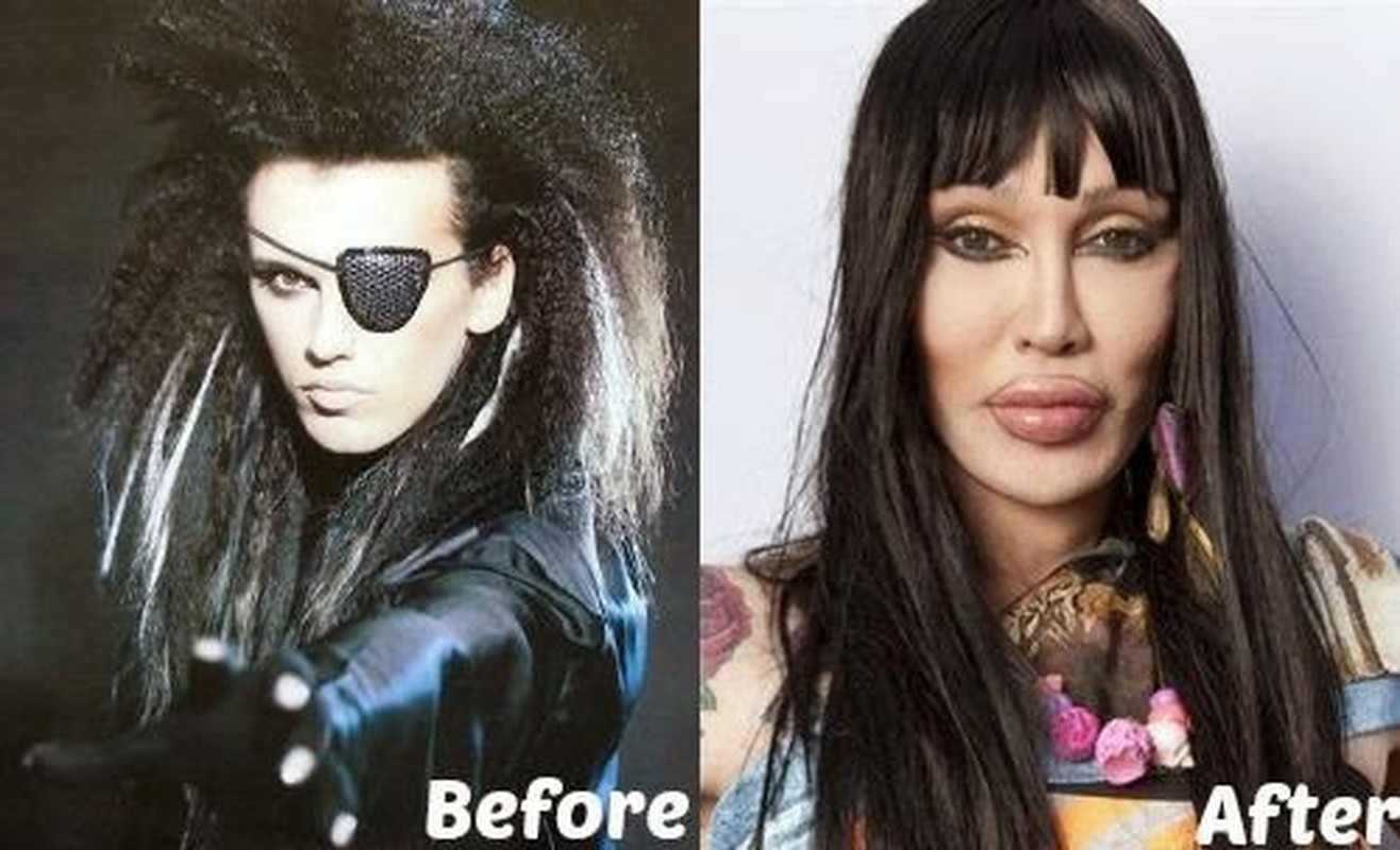 Pete Burns thay doi the nao sau 300 lan phau thuat tham my