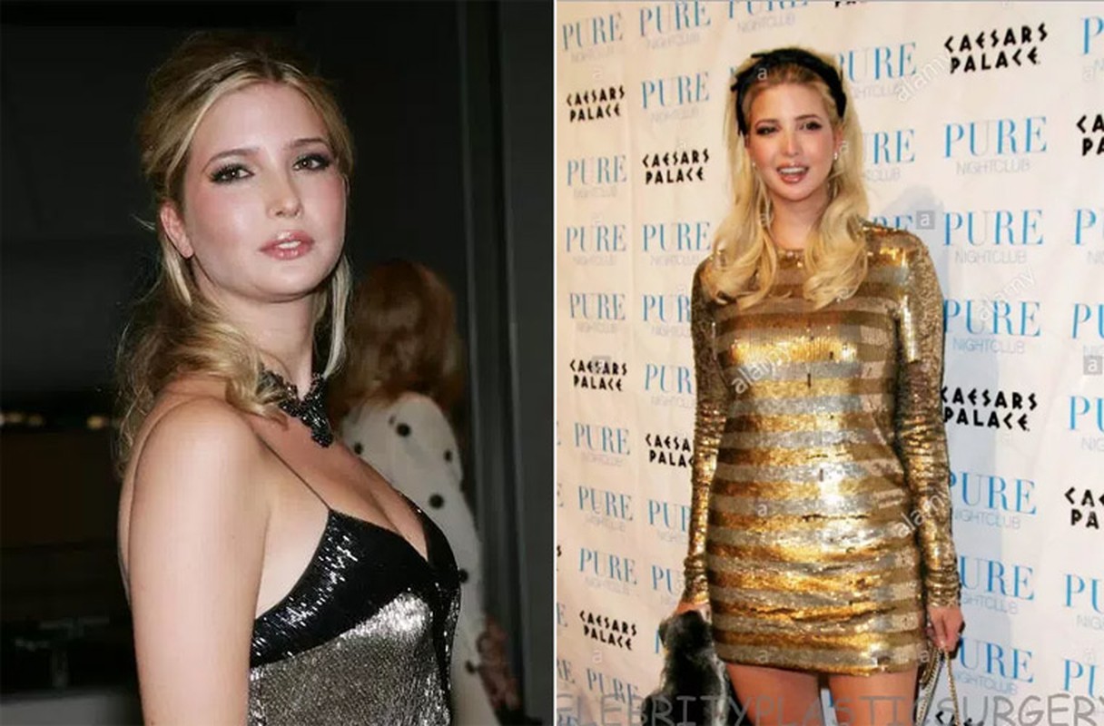 Lo bang chung nghi phau thuat tham my cua Ivanka Trump-Hinh-4